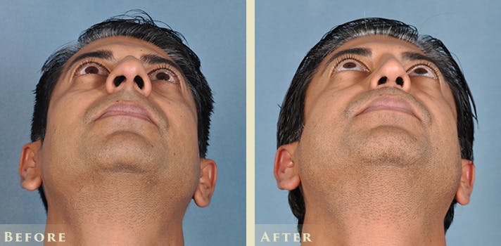 Aesthetic Rhinoplasty Before & After Gallery - Patient 103880 - Image 4