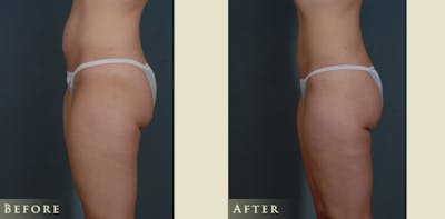 Female Liposuction Before & After Gallery - Patient 309315 - Image 4