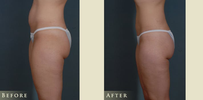 Female Liposuction Before & After Gallery - Patient 309315 - Image 4