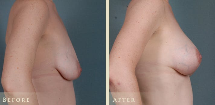 Breast Augmentation and Lift  Before & After Gallery - Patient 323669 - Image 3