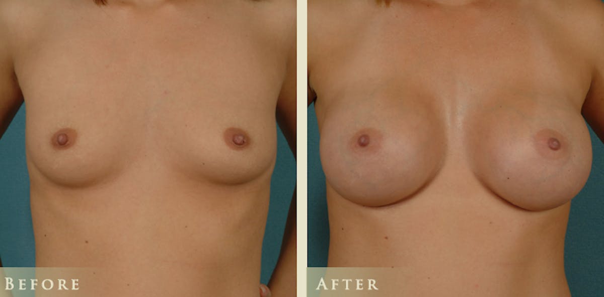 Breast Augmentation with Saline Implants Before & After Gallery - Patient 314890 - Image 1