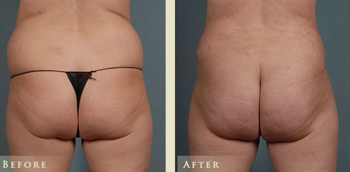 Brazilian Butt Lift Before & After Gallery - Patient 671400 - Image 1