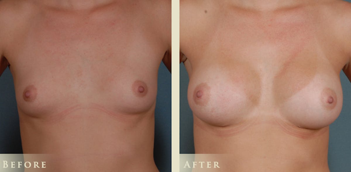 Breast Augmentation with Silicone Implants Before & After Gallery - Patient 121123 - Image 1