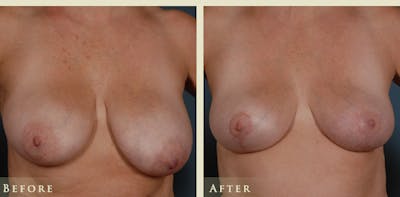 Breast Lift Before & After Gallery - Patient 389228 - Image 1