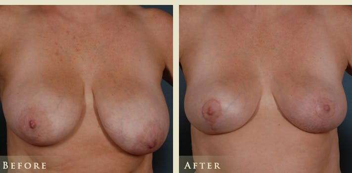 Breast Lift Before & After Gallery - Patient 389228 - Image 1