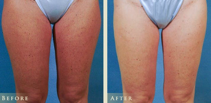 Female Liposuction Before & After Gallery - Patient 862765 - Image 1
