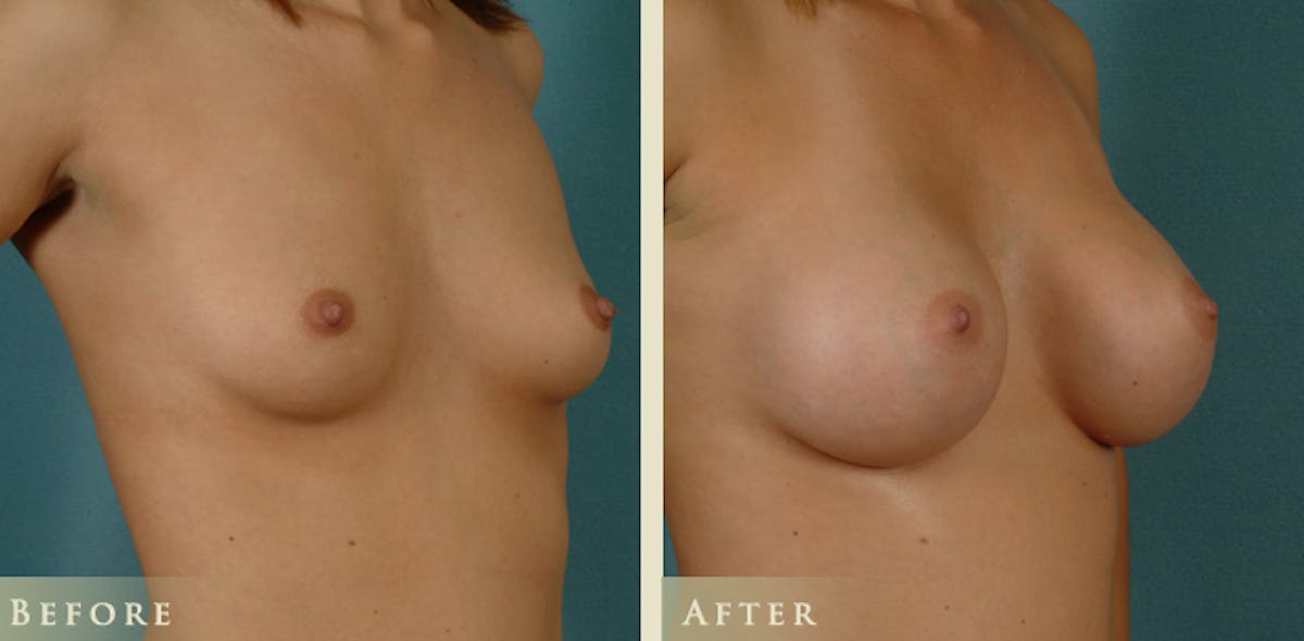 Breast Augmentation with Saline Implants Before & After Gallery - Patient 314890 - Image 2