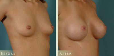 Breast Augmentation Before & After Gallery - Patient 193076 - Image 2