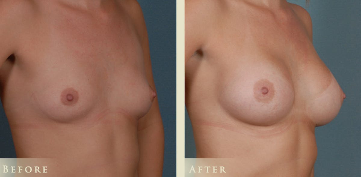 Breast Augmentation with Silicone Implants Before & After Gallery - Patient 121123 - Image 2
