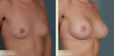 Breast Augmentation Before & After Gallery - Patient 121123 - Image 2