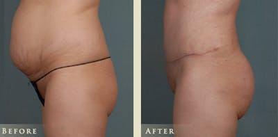 Brazilian Butt Lift Before & After Gallery - Patient 671400 - Image 2