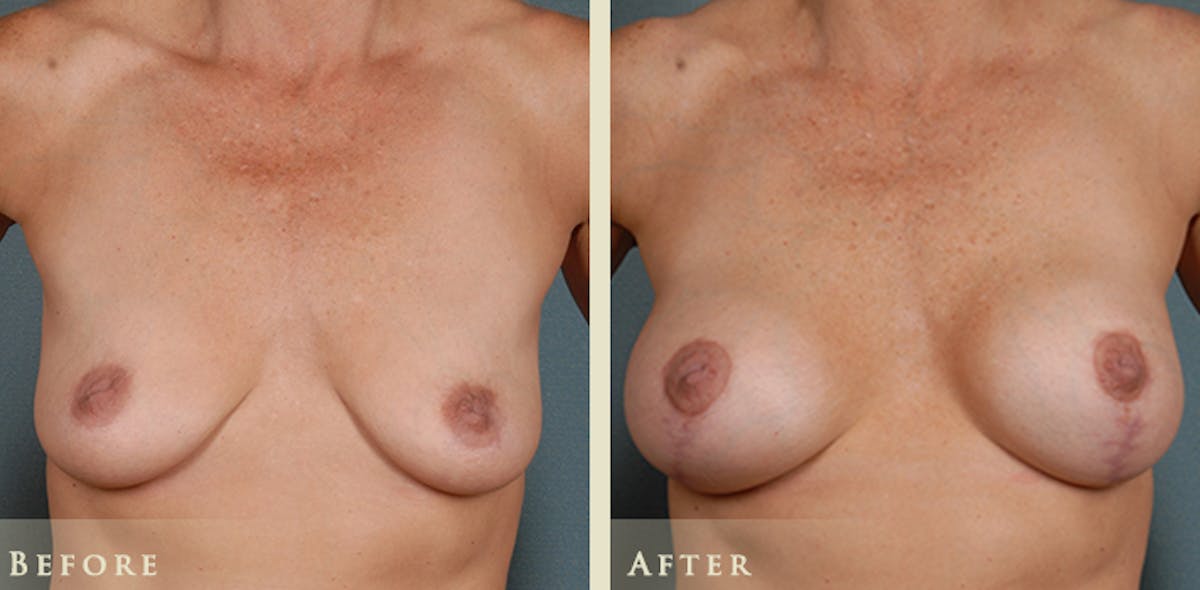 Breast Augmentation and Lift  Before & After Gallery - Patient 260580 - Image 1