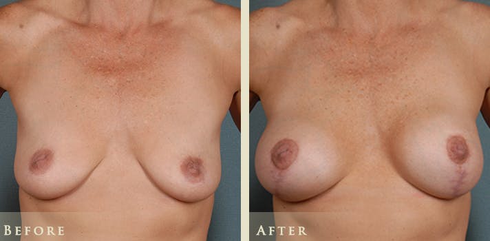 Breast Augmentation and Lift Before & After Gallery - Patient 260580 - Image 1