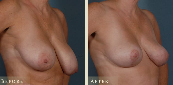Breast Lift Before & After Gallery - Patient 389228 - Image 2
