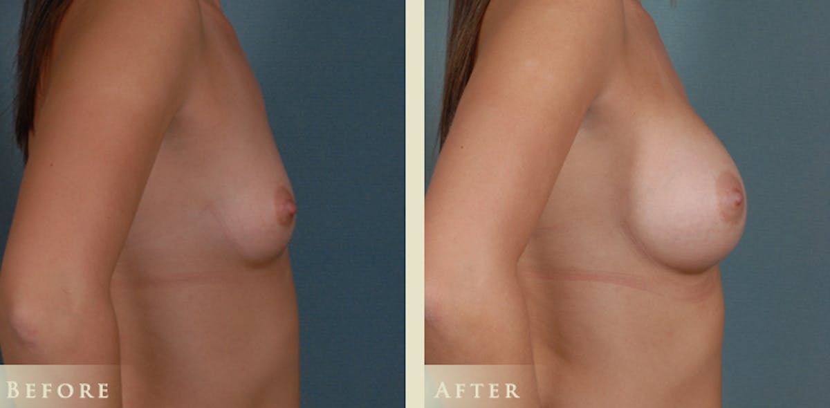 Breast Augmentation with Silicone Implants Before & After Gallery - Patient 121123 - Image 3