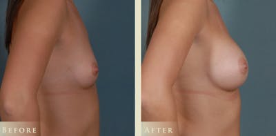 Breast Augmentation Before & After Gallery - Patient 121123 - Image 3