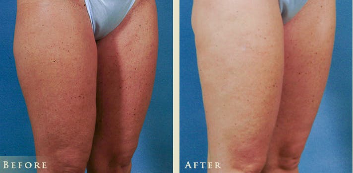 Female Liposuction Before & After Gallery - Patient 862765 - Image 2