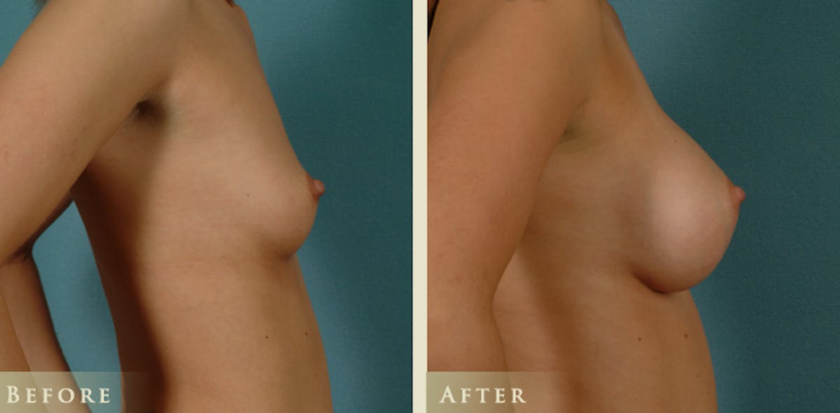 Breast Augmentation with Saline Implants Before & After Gallery - Patient 314890 - Image 3
