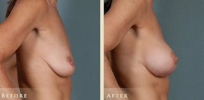 Breast Augmentation and Lift Before & After Gallery - Patient 260580 - Image 2