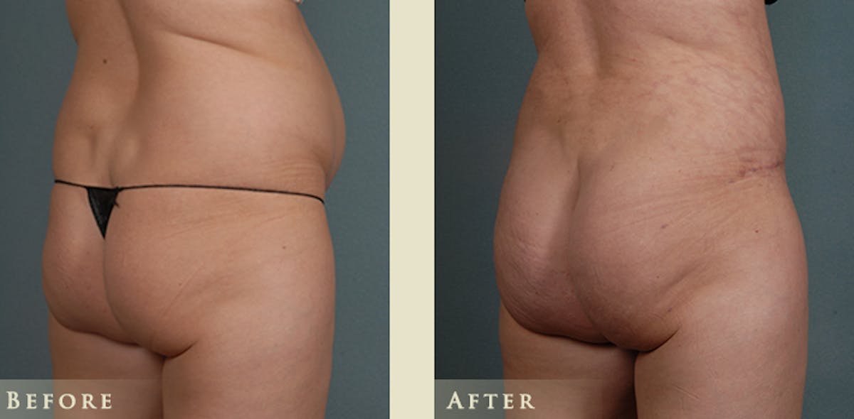 Brazilian Butt Lift Before & After Gallery - Patient 671400 - Image 3