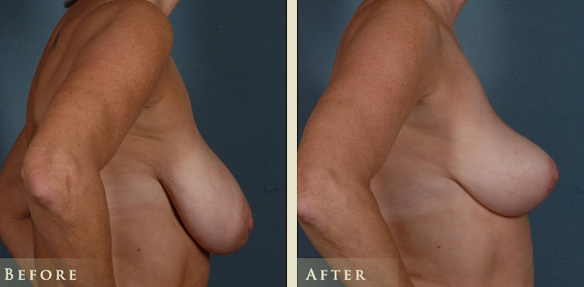 Breast Reduction Before & After Gallery - Patient 765647 - Image 3