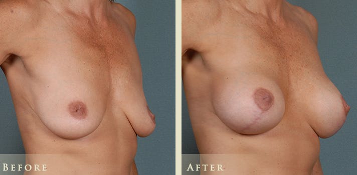 Breast Augmentation and Lift Before & After Gallery - Patient 260580 - Image 3