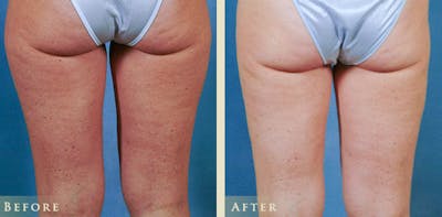 Female Liposuction Before & After Gallery - Patient 862765 - Image 3