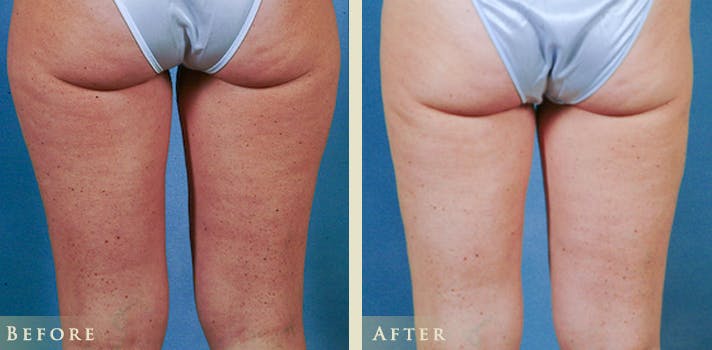Female Liposuction Before & After Gallery - Patient 862765 - Image 3