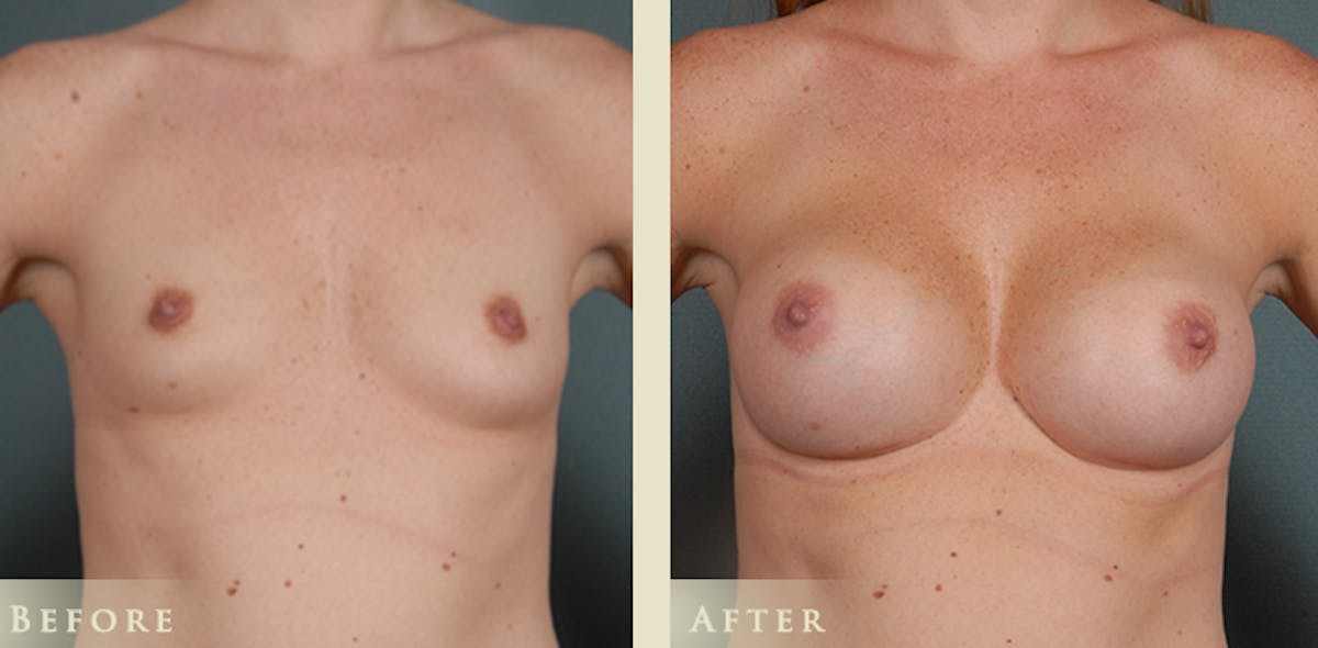Breast Augmentation with Silicone Implants Before & After Gallery - Patient 537139 - Image 1