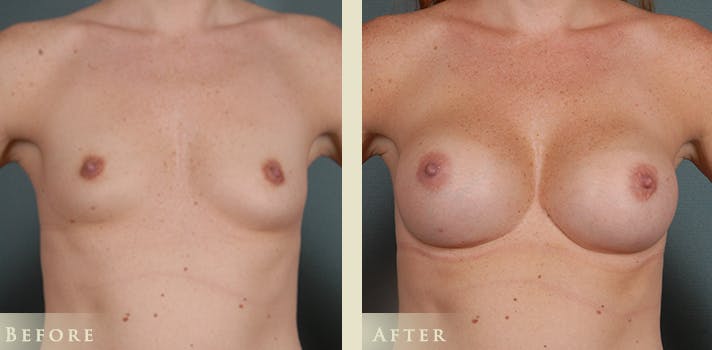 Breast Augmentation Before & After Gallery - Patient 537139 - Image 1