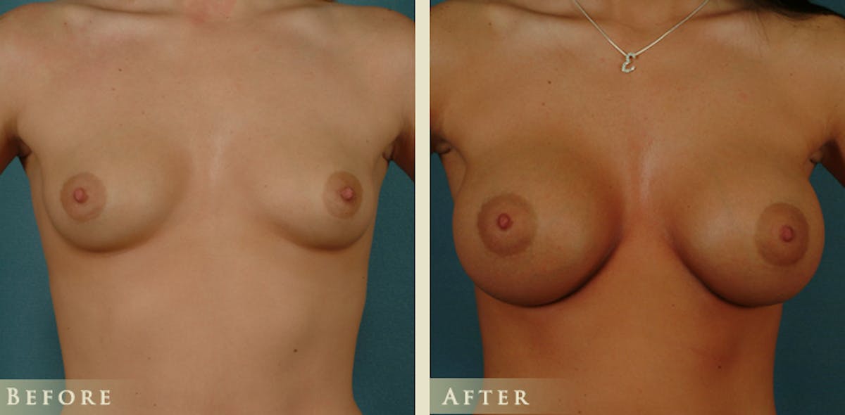 Breast Augmentation with Saline Implants Before & After Gallery - Patient 890465 - Image 1