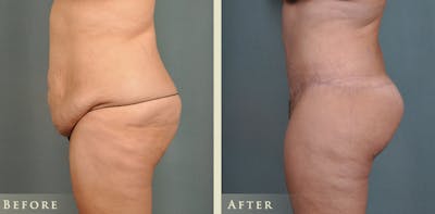 Brazilian Butt Lift Before & After Gallery - Patient 326485 - Image 1