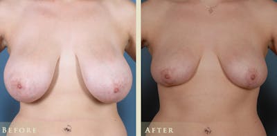 Breast Reduction Before & After Gallery - Patient 158720 - Image 1