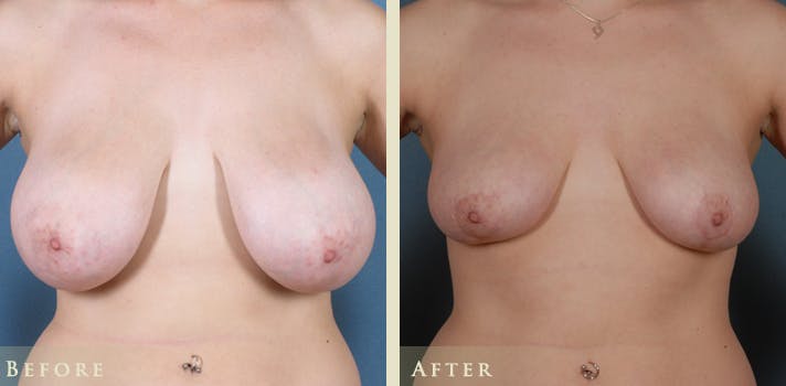 Breast Reduction Before & After Gallery - Patient 158720 - Image 1