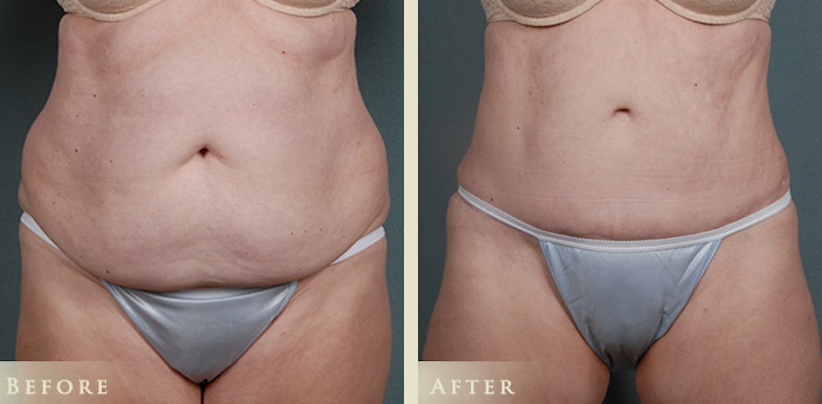 Tummy Tuck Before & After Gallery - Patient 363613 - Image 1
