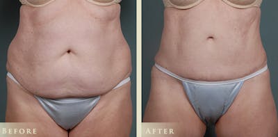 Tummy Tuck Before & After Gallery - Patient 363613 - Image 1