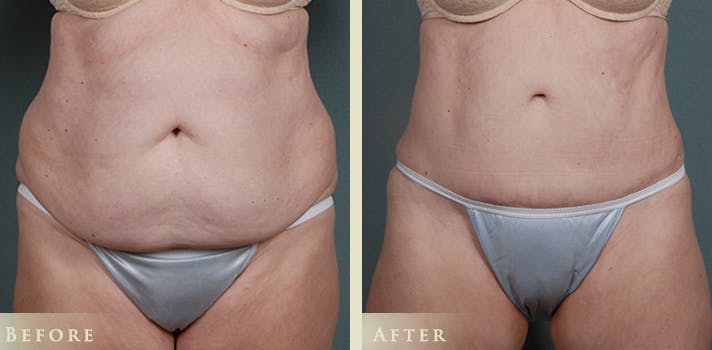Tummy Tuck Before & After Gallery - Patient 363613 - Image 1
