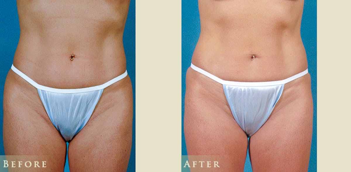 Female Liposuction Before & After Gallery - Patient 629448 - Image 1
