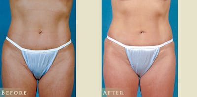 Female Liposuction Before & After Gallery - Patient 629448 - Image 1