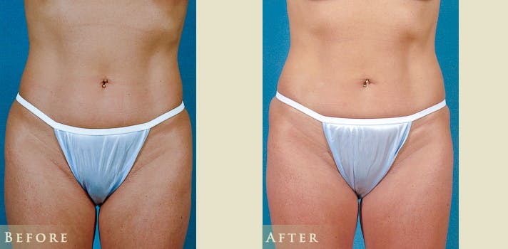 Female Liposuction Before & After Gallery - Patient 629448 - Image 1