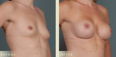 Breast Augmentation Before & After Gallery - Patient 537139 - Image 2