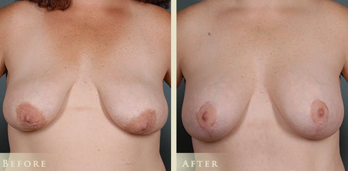 Breast Augmentation and Lift  Before & After Gallery - Patient 165909 - Image 1