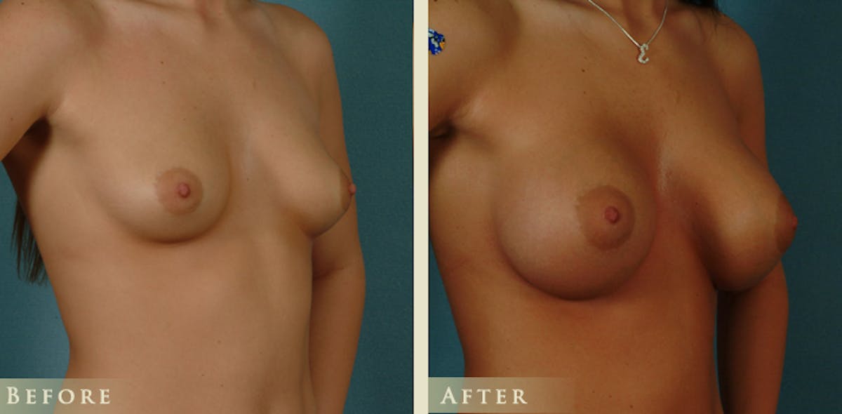 Breast Augmentation with Saline Implants Before & After Gallery - Patient 890465 - Image 2