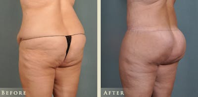 Brazilian Butt Lift Before & After Gallery - Patient 326485 - Image 2