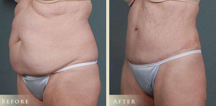Tummy Tuck Before & After Gallery - Patient 363613 - Image 2