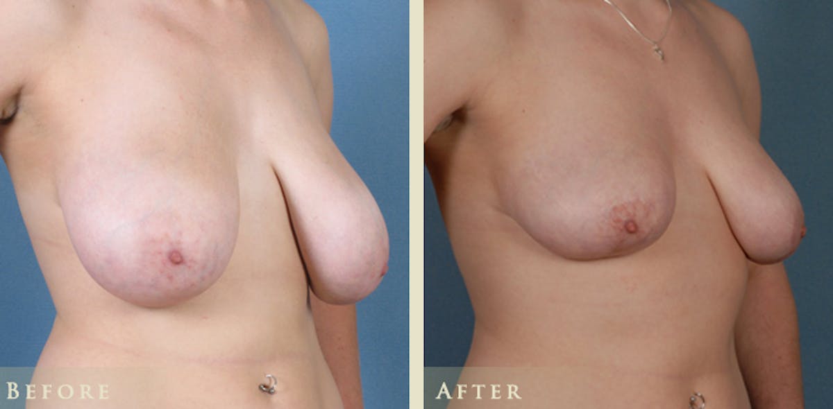 Breast Reduction Before & After Gallery - Patient 158720 - Image 2