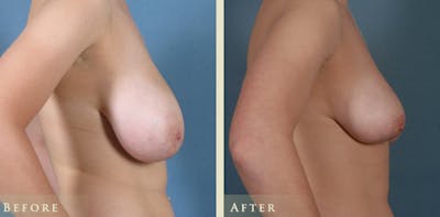 Breast Reduction Before & After Gallery - Patient 158720 - Image 3