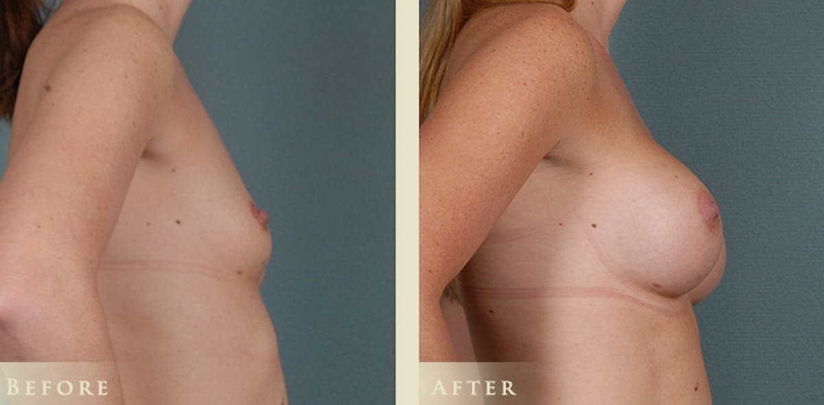 Breast Augmentation with Silicone Implants Before & After Gallery - Patient 537139 - Image 3