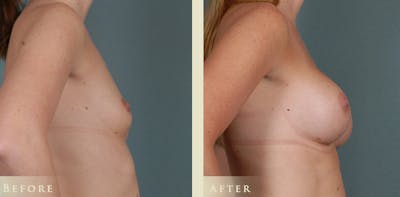 Breast Augmentation Before & After Gallery - Patient 537139 - Image 3