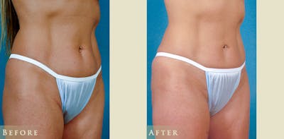 Female Liposuction Before & After Gallery - Patient 629448 - Image 2